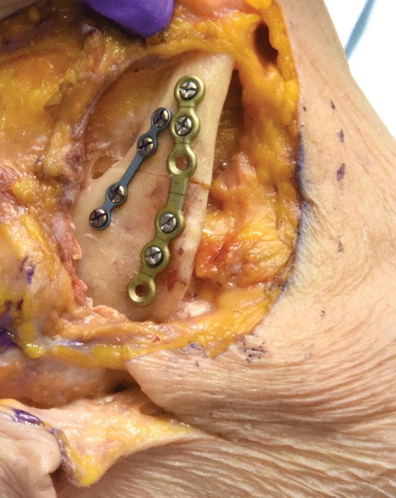 This clinical photograph from a surgical simulation depicts the internal fixation of a mandibular fracture in a cadaveric model. The image shows an intraoperative view of the exposed mandible, demonstrating the application of two distinct rigid fixation plates. A superior gold-colored tension band plate is secured across the fracture line with monocortical locking screws; it features four filled screw holes and one empty terminal hole. Paralleling this, an inferior blue-toned plate is fixed with four bicortical locking screws with visible Phillips-style heads. The surgical field displays anatomical landmarks including the bone cortex, yellow subcutaneous adipose tissue, and muscle fibers. Surgical markings in blue ink are visible on the surrounding skin and soft tissue. The educational focus of this image is the demonstration of load-sharing osteosynthesis principles and the specific hardware placement required for stable mandibular fracture reduction in maxillofacial surgery.