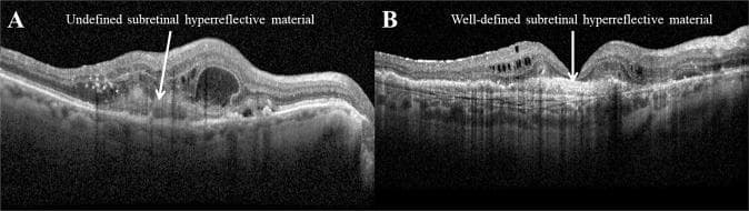 This diagnostic comparison chart utilizes cross-sectional optical coherence tomography (OCT) imaging to demonstrate two distinct morphological presentations of subretinal hyperreflective material (SHRM) in the context of neovascular age-related macular degeneration (nAMD). Image A illustrates 'Undefined SHRM,' characterized by a lesion with relatively low reflectivity and hazy, indistinct borders that blend into the surrounding retinal neural layers. Adjacent intraretinal fluid (hyporeflective spaces) is also visible. Image B illustrates 'Well-defined SHRM,' presenting as a high-reflectivity mass with sharp, clearly delineated boundaries that separate it from the overlying neurosensory retina. The presence and characterization of SHRM serve as critical biomarkers for visual prognosis, as the material often represents a precursor to subretinal fibrosis or the presence of choroidal neovascularization (CNV). The educational focus highlights the importance of distinguishing border definition and internal reflectivity for clinical staging and monitoring treatment response to anti-VEGF therapy.