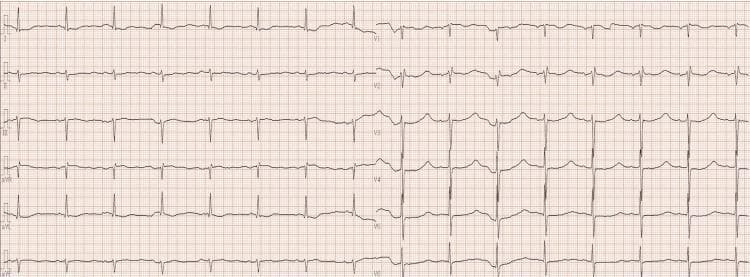 This diagnostic image is a 12-lead electrocardiogram (ECG) recorded on standard grid paper. The tracing demonstrates hallmark visual findings associated with severe hypokalemia. Key electrocardiographic features include significant T-wave flattening across multiple leads, most notably in leads I, II, aVF, V5, and V6, where the T-waves appear almost isoelectric. There is a corresponding appearance of prominent, positive U-waves, which are particularly distinct in the precordial leads V3 through V6. In these leads, the U-wave amplitude is nearly equal to or exceeds the amplitude of the preceding flattened T-wave, creating a characteristic 'camel-hump' morphology or a false impression of a prolonged QT interval (often referred to as a QU interval). The rhythm is sinus, and the primary educational focus is the recognition of electrolyte-induced repolarization abnormalities. This ECG is clinically significant for identifying severe potassium depletion, such as that caused by diuretic use or pseudo-aldosteronism.
