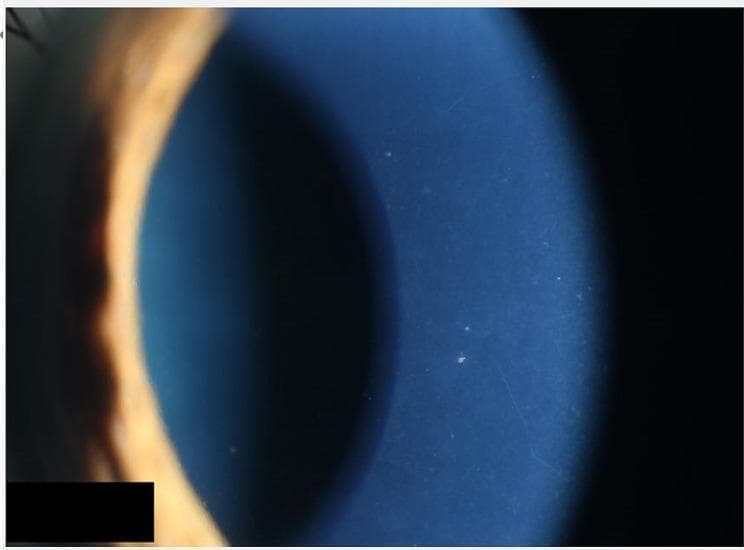 A close-up clinical photograph of the human eye, captured via slit-lamp biomicroscopy, focusing on the cornea and anterior chamber. The image demonstrates hallmark signs of anterior uveitis, specifically the presence of numerous small, white keratic precipitates (KPs) adhered to the posterior surface of the corneal endothelium. These precipitates are fine to medium in size and appear scattered across the inferior and central corneal zones. There is a perceptible degree of generalized corneal haziness, indicative of mild corneal edema or an active inflammatory process within the anterior segment. The peripheral iris is visible on the left margin, showing normal contour, though the overall clarity of the intraocular structures is slightly diminished by the overlying corneal changes. This visual is characteristic of inflammatory conditions such as Posner-Schlossman syndrome or viral-induced uveitis, highlighting the clinical presentation of secondary glaucoma or hypertensive uveitis as indicated by the associated clinical context.