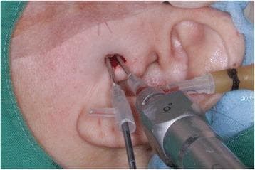 This intraoperative clinical photograph depicts a minimally invasive temporomandibular joint (TMJ) arthroscopy and arthrocentesis procedure. The anatomical focus is the preauricular region, where two surgical instruments are inserted into the superior joint space. The primary instrument is an ultra-thin rigid nanoscope arthroscope, introduced through a specialized Chung’s needle that features a dedicated irrigation port connected to fluid tubing. Adjacent to this, a second portal facilitates the insertion of a metallic surgical trocar for mechanical lysis of adhesions. The entry points are positioned anterior to the tragus of the ear, targeting the articular fossa. Visible clinical signs include a small amount of blood and fluid at the puncture sites, consistent with an active invasive procedure. This visual demonstrates the dual-portal technique used in oral and maxillofacial surgery to diagnose and treat internal derangements of the TMJ, such as chronic closed lock or anterior disc displacement without reduction.