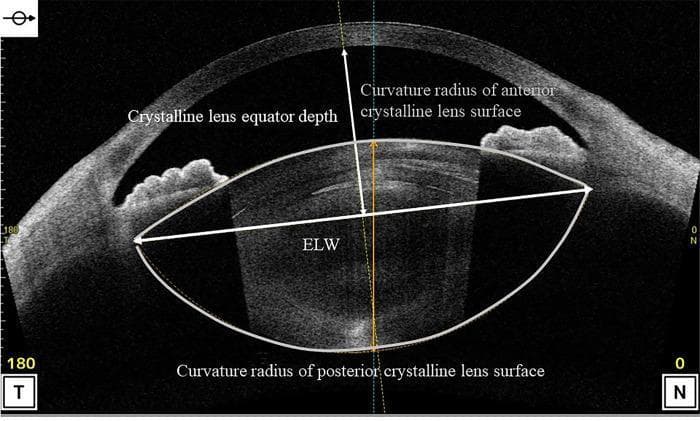 This diagnostic image is an Anterior Segment Optical Coherence Tomography (AS-OCT) cross-section of the human eye, specifically used for preoperative cataract surgery analysis. The image depicts the anatomical structures of the anterior segment, including the curved cornea at the top and the biconvex crystalline lens positioned posteriorly. Key clinical parameters are annotated to describe the lens morphology and spatial relationship to corneal structures. The 'Crystalline lens equator depth' is marked by a vertical arrow extending from the posterior corneal surface (CP) to the equatorial plane. The 'ELW' (Equatorial Lens Width) is represented by a horizontal white line across the widest part of the lens. Additional annotations highlight the 'Curvature radius of anterior crystalline lens surface' and 'Curvature radius of posterior crystalline lens surface,' indicated by solid white arcs outlining the lens boundaries. Orientation markers 'T' (Temporal) and 'N' (Nasal) are visible at the bottom. This image serves as a pedagogical tool for understanding biometric measurements necessary for predicting postoperative intraocular lens (IOL) position and stability.