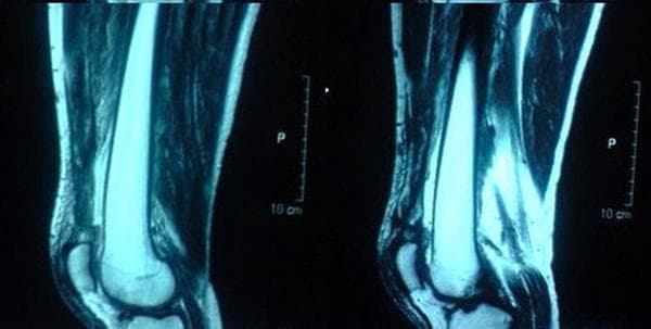 This diagnostic image consists of two sagittal T2-weighted MRI views of the bilateral knees, demonstrating a bilateral quadriceps tendon rupture. The pathology is characterized by a complete midsubstance disruption of the quadriceps tendon approximately 1.5 cm proximal to its insertion into the superior pole of the patella. The right knee shows a more extensive retraction and disruption compared to the left. Key findings include visible thickening and abnormal signal intensity in the remaining tendon segments, indicative of pre-existing tendinosis or degeneration. While the sagittal views highlight the tendon gap and associated soft tissue edema/hemarthrosis, clinical context suggests associated lateral patellar tilt and retinacular injury. This case is an educational example of simultaneous bilateral quadriceps rupture, a rare clinical entity often associated with systemic metabolic conditions or chronic tendon degeneration. The imaging is critical for surgical planning to differentiate between osteotendinous avulsion and midsubstance tears.