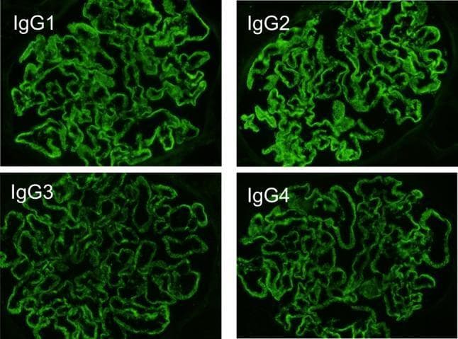 This diagnostic image consists of a four-panel comparison of direct immunofluorescence (DIF) microscopy findings from a renal biopsy. Each panel displays a glomerulus stained for a specific IgG subclass: IgG1, IgG2, IgG3, and IgG4. All four subclasses demonstrate a positive, bright green fluorescent signal. The staining pattern is diffuse and granular, localized predominantly along the glomerular capillary loops, outlining the basement membrane. The distribution is global and relatively uniform across all four images, which is a characteristic finding in lupus-like membranous nephropathy (MN). This multi-subclass deposition (full-house pattern for IgG) helps clinically differentiate secondary causes of membranous nephropathy, such as Systemic Lupus Erythematosus (SLE), from primary membranous nephropathy, which typically shows a predominance of IgG4. The intensity of the fluorescence indicates significant immune complex deposition within the subepithelial space of the glomerular filtration barrier.