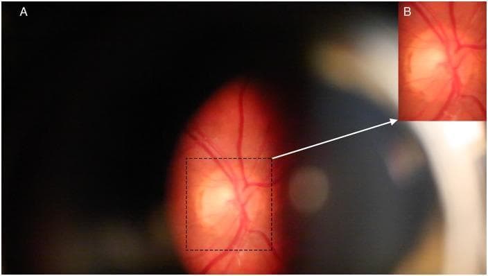 This clinical photograph displays a fundus view of a human retina obtained via an imaging slit-lamp and digital camera. Panel A presents a full-frame view as observed through a Meditron ophthalmodynamometer, showing the optic disc as a bright, pale, yellowish-white structure. Retinal arteries and veins emerge from the disc, branching across a mottled orange-red background. The image contains peripheral artifacts, including a large dark region on the left and slight blurring. Panel B is a magnified inset of the region of interest defined by a dashed box in Panel A. This cropped view provides higher detail of the optic disc and the distribution of proximal retinal vasculature. The educational focus of this image is the visualization of the optic nerve head and the associated vascular network for the analysis of retinal vascular pulsations and hemodynamic changes under induced intraocular pressure. Key anatomical features include the optic disc, retinal arteries, and retinal veins, which are essential for studies in ophthalmology and neuro-ophthalmology.