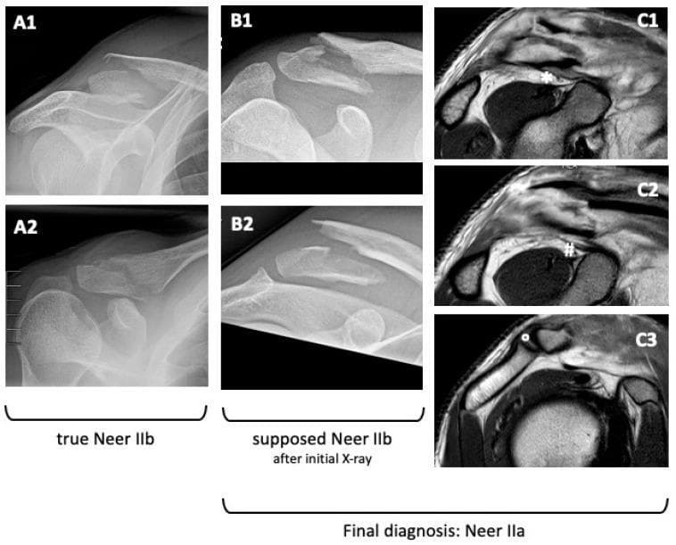This composite educational image features a Comparison Chart of diagnostic modalities for distal clavicle fractures, contrasting X-ray findings with MRI for classification accuracy. Panels A1-A2 and B1-B2 show standard radiographic views (AP and Rockwood) of distal clavicle fractures. A1-A2 demonstrate a 'true Neer IIb' fracture, characterized by significant superior displacement of the proximal fragment due to coracoclavicular (CC) ligament disruption. Panels B1-B2 display a fracture initially suspected as Neer IIb based on displacement; however, subsequent MRI (panels C1-C3) reveals a different ligamentous status. In the MRI views, the conoid ligament (marked by #) and trapezoid ligament (marked by *) are seen intact and attached to the distal fracture fragment, while the acromioclavicular capsule/ligament (marked by °) is also preserved. This confirms a final diagnosis of Neer IIa. The image serves as a clinical teaching tool for orthopedic surgeons to distinguish between stable and unstable distal clavicle fractures by correlating bony displacement on X-ray with soft-tissue/ligamentous integrity on MRI.