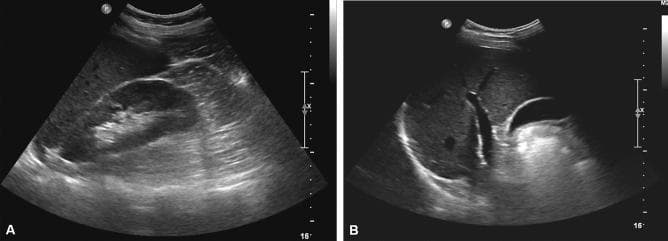 Two B-mode ultrasound images (A and B) of the liver in a 41-year-old male with nonalcoholic fatty liver disease (NAFLD). Image A shows a longitudinal view of the right upper quadrant, comparing the echogenicity of the hepatic parenchyma to the right renal cortex; the liver appears isoechoic to the kidney, which is a finding typically interpreted as no ultrasound-evident fatty liver. Image B provides a broader view of the hepatic anatomy, demonstrating clear visualization of the hepatic vessel walls and the curvilinear, hyperechoic diaphragm. There is an absence of visual indicators for chronic liver disease or cirrhosis, such as surface nodularity or coarse parenchymal texture. These images illustrate a case of discordant findings where B-mode ultrasound failed to detect hepatic steatosis that was otherwise confirmed by a high MRI proton density fat fraction (MRI-PDFF) of 9.1%. This case serves as an educational example of the sensitivity limitations of qualitative B-mode ultrasonography in detecting mild steatosis.