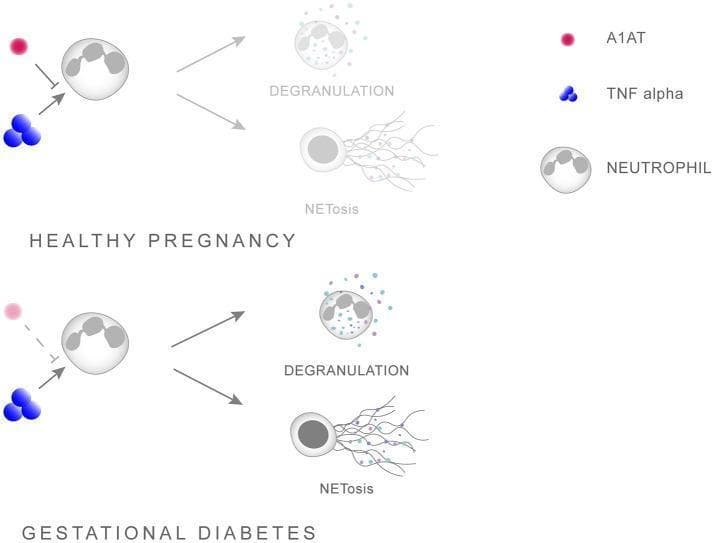 This pathophysiology diagram illustrates the regulatory role of Alpha-1 Antitrypsin (A1AT) in neutrophil priming during healthy pregnancy versus Gestational Diabetes Mellitus (GDM). The schematic identifies three primary components: A1AT (red circle), TNF-alpha (blue spheres), and Neutrophils (gray cells with multi-lobed nuclei). In a 'Healthy Pregnancy' scenario, A1AT acts as an inhibitory mediator, blocking the interaction between TNF-alpha and the neutrophil, thereby limiting inflammatory activation. In contrast, the 'Gestational Diabetes' section depicts a reduced or weakened presence of A1AT (represented by a faded red circle and dashed inhibitory line), allowing TNF-alpha to unimpededly prime the neutrophil. Both pathways culminate in two downstream effector processes: 'DEGRANULATION,' shown as the release of cytoplasmic granules, and 'NETosis,' visualized as the ejection of extracellular chromatin traps (stringy extensions). The diagram highlights how a shift in the A1AT/TNF-alpha balance in GDM promotes hyper-inflammation through enhanced neutrophil activation, making it a critical educational resource for understanding inflammatory signaling and obstetric complications.
