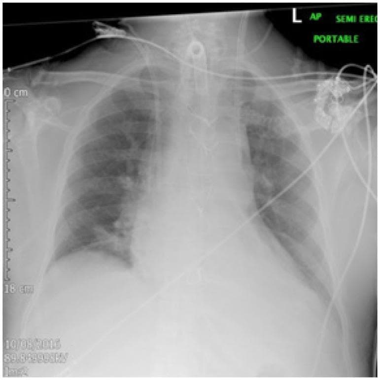 This diagnostic image is an anteroposterior (AP) portable semi-erect chest radiograph demonstrating a malpositioned dialysis catheter. The primary finding is a radiopaque double-lumen dialysis catheter entering via the left internal jugular vein. Rather than following the expected course into the superior vena cava, the catheter tip is positioned anomalously within the mediastinum, directed toward the left hilum. The image displays the cardiothoracic silhouette, ribs, and clavicles, with an endotracheal tube and additional monitoring lines also visible. The lung fields are largely clear, though limited by image quality, with sharp costophrenic angles. This visual serves as a critical educational example of central venous access complications, illustrating the importance of post-procedural radiographic verification to identify improper placement and potential vascular anomalies, such as an anomalous left superior pulmonary vein or persistent left superior vena cava.