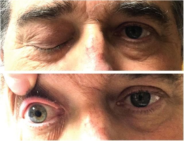 This clinical photograph consists of a two-panel vertical comparison demonstrating a cranial nerve III (oculomotor nerve) palsy. The top panel shows a front-facing view of a patient with complete right-sided ptosis, where the right upper eyelid is fully closed in contrast to the normal eyelid position and appearance of the left eye. The bottom panel shows the clinician manually elevating the right upper eyelid, revealing an ipsilateral fixed and dilated pupil (mydriasis) and a slightly bloodshot sclera. The left pupil appears smaller and reactive. These visual findings—ptosis and a large, non-reactive pupil—are characteristic signs of oculomotor nerve dysfunction, often associated with compressive lesions or infiltrative processes such as cavernous sinus involvement or skull base tumors. This material is used in medical education to teach the clinical presentation of multiple cranial neuropathies and the physical examination techniques for neuro-ophthalmological assessment.