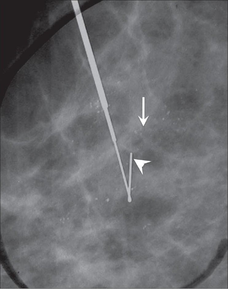 This diagnostic mammogram displays a magnified view of breast tissue featuring amorphous calcifications and a localization device. The image shows several hazy, indistinct, and tiny microcalcifications (indicated by a white arrow) distributed in a scattered, amorphous pattern. These calcifications lack a clearly defined shape or branching morphology. A metallic hook-wire localization needle (indicated by a white arrowhead) is visible, with its distal 'V-shaped' hook positioned adjacent to the cluster of calcifications to facilitate surgical excision or biopsy. The mammographic background shows fibroglandular density. This visual demonstrates a standard preoperative localization procedure for indeterminate or suspicious breast calcifications that are not palpable. The educational focus is on identifying amorphous calcification morphology and understanding the radiographic appearance of a hook-wire localization device used in breast imaging interventions.