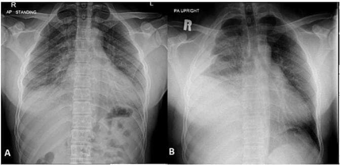This diagnostic comparison contains two frontal chest X-rays (A and B) illustrating the development of a large pleural effusion. X-ray A, taken on initial admission, shows a relatively normal chest with clear lung fields, sharp costophrenic angles, and a centrally positioned mediastinum. X-ray B, a subsequent study, demonstrates a significant dense opacity in the right lower and middle zones of the hemithorax. This opacity exhibits a classic meniscus sign, curving upward along the lateral chest wall, which is highly characteristic of a large pleural effusion (later confirmed as a hemothorax). The right hemidiaphragm and costophrenic angle are completely obscured by the fluid. There is a subtle mass effect resulting in a slight shift of the mediastinal structures towards the left. The left lung remains clear. These images are used in medical education to demonstrate the radiographic progression of pleural pathology and the visual criteria for identifying fluid accumulation in the pleural space.