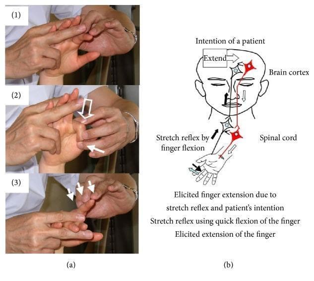 This composite educational graphic illustrates the Repetitive Facilitative Exercise (RFE) technique for hemiplegic fingers, divided into a clinical demonstration and a pathophysiology diagram. Panel (a) shows a three-step manual therapy sequence: (1) quick passive finger flexion to elicit a stretch reflex; (2) simultaneous manual flexion of the metacarpophalangeal (MP) joint with an 'Extend' verbal cue to facilitate voluntary effort; and (3) application of slight resistance during finger extension to maintain the alpha-gamma linkage and muscle contraction. Panel (b) provides a neuroanatomical schematic depicting the hypothesized mechanism. It labels the brain cortex and spinal cord, tracing a dual pathway where the 'intention of the patient' (descending motor tracts) is combined with sensory input from 'stretch reflex by finger flexion' (ascending/local arcs). The integration of these signals at the spinal level is shown to result in 'elicited finger extension.' This visual is intended for rehabilitation specialists and physical therapists focusing on neuroplasticity and motor recovery in stroke or hemiplegic patients.