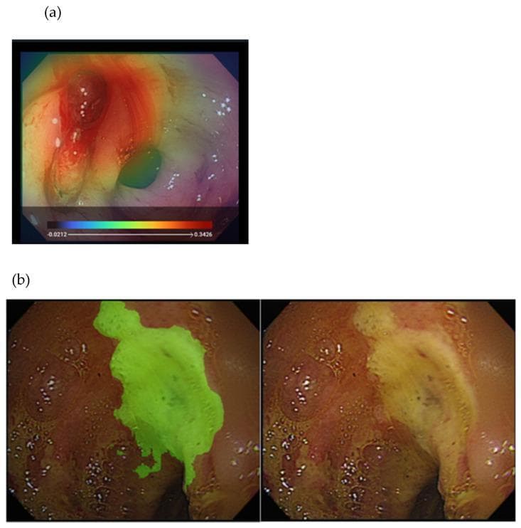 This composite image illustrates deep learning (DL) applications for identifying and segmenting gastrointestinal pathology during endoscopy, specifically for peptic ulcer disease (PUD). Panel (a) presents an endoscopic view of an active bleeder with a Grad-CAM heatmap overlay. The heatmap uses a pseudocolor scale where warmer tones (red, orange) signify areas of high clinical significance or high probability of active bleeding, concentrated around the lesion, while cooler tones (blue, green) represent lower-risk areas. Panel (b) shows a side-by-side comparison of a gastric or duodenal ulcer. The right frame displays the original endoscopic image showing a yellowish-white ulcer base with irregular borders and surrounding erythema. The left frame demonstrates computer-aided semantic segmentation, where the ulcer bed is highlighted with a green overlay, precisely demarcating the lesion's boundaries from healthy mucosa. These visualizations serve as educational examples of how artificial intelligence can assist in the endoscopic classification of bleeding risks, such as the Forrest classification, by providing objective lesion identification and risk assessment.