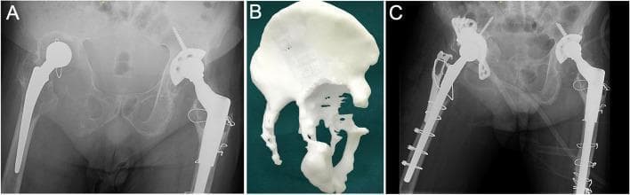 This composite figure illustrates a complex case of failed total hip arthroplasty (THA) and its subsequent revision. Image A is an anteroposterior (AP) pelvic radiograph of a 54-year-old male demonstrating bilateral hip prostheses. The right hip shows clear signs of prosthetic aseptic loosening 24 years post-operation, characterized by significant radiolucency around the acetabular cup and proximal femoral stem. Image B displays a 3D-printed additive manufacturing (AM) model of the patient’s right pelvis. This anatomical diagram highlights severe Type IV pelvic osteolysis with massive bone defects in the superior and inferior acetabulum, ischial ramus, and pubic ramus, rendering the acetabular ring non-functional. Image C is a post-operative AP radiograph showing the reconstruction of the right hip using a customized cage fixed with multiple screws and cerclage wires. The educational focus is on identifying extensive periprosthetic bone loss and the challenges of achieving mechanical stability in revision arthroplasty when native bone stock is insufficient for standard commercial implants.