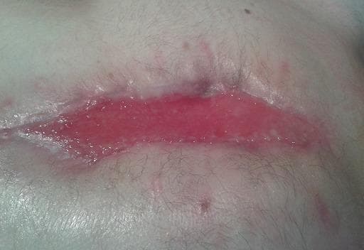 This clinical photograph displays a healing surgical wound on the anterior chest, following an omentoplasty (epiplooplasty) for the management of post-sternotomy mediastinitis. The wound bed is characterized by a central, horizontal, fusiform area of beefy-red granulation tissue, indicating active angiogenesis and secondary intention healing. The surface of the granulation tissue appears moist and glistening, with no evidence of purulent exudate or slough. The wound margins show signs of epithelialization, visible as a pale, whitish-pink rim of new tissue migrating inward. The surrounding periwound skin exhibits mild, diffuse erythema consistent with normal inflammatory response in the proliferative phase of healing. Fine terminal hair is visible on the surrounding thoracic skin. This image serves as a clinical example of using an omental flap to provide vascularized coverage for a complex sternal wound, facilitating eventual complete cicatrization.
