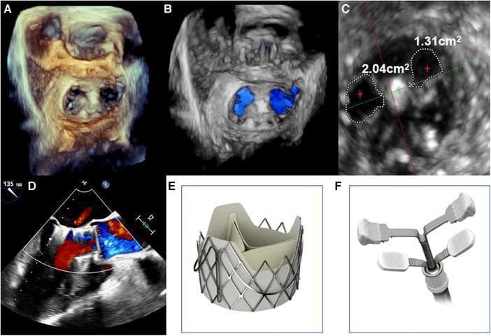 This composite figure illustrates the procedural results of combined transcatheter aortic valve replacement (TAVI) and transcatheter edge-to-edge repair (TEER) of the mitral valve. Panels A and B display 3D transesophageal echocardiography (TEE) reconstructions showing the mitral valve in a surgical 'en face' view, revealing the dual-orifice morphology created by the placement of a central clip (MVC-IIIf) between the A2 and P2 leaflets. Panel C provides a quantitative planimetric analysis of the mitral valve area, showing two distinct orifices measuring 2.04 cm² and 1.31 cm² post-repair. Panel D features a color Doppler TEE image assessing hemodynamic status; it demonstrates the resolution of mitral regurgitation and shows mild residual paravalvular regurgitation at the aortic position. Panels E and F provide reference illustrations of the specific medical devices used: a J-Valve transcatheter heart valve and the MVC-IIIf mitral valve clip. This content serves to demonstrate advanced structural heart interventions and post-procedural imaging assessment for cardiology and cardiothoracic surgery education.