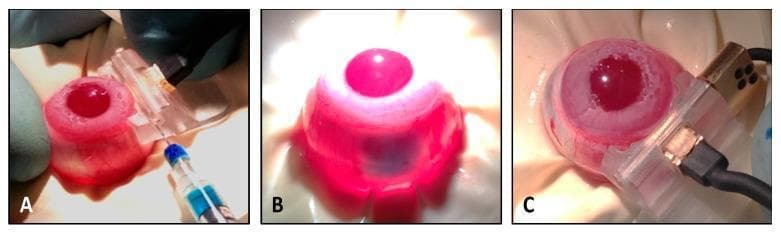 This composite of three intraoperative clinical photographs demonstrates a ciliary muscle electrotransfection procedure in a rabbit model, showcasing a method for ocular gene therapy. Panel A illustrates the initial step where a clear, dedicated ocular stabilization device is placed on the nasal scleral surface. A syringe with a 29G needle is used to perform a precise injection of a plasmid solution (highlighted with blue tracer dye) into the ciliary muscle fibers. Panel B provides a close-up view of the eye following injection, showing the localized distribution of the blue tracer dye within the ocular tissue for demonstration of anatomical targeting. Panel C depicts the subsequent electrotransfection step; the ocular device is aligned with the limbus to guide the insertion of a metallic comb electrode into the ocular tissues. This electrode, connected via a black cable to a pulse generator, facilitates the delivery of square-wave electrical pulses to enhance cellular plasmid uptake. The images serve as an educational resource for non-viral gene delivery techniques and ocular surgical maneuvers.