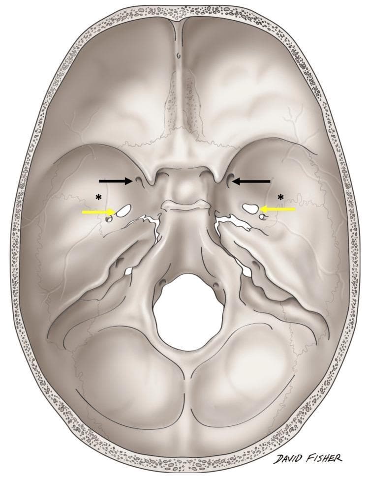 Anatomical Diagram: Superior view (internal aspect) of the human skull base. This medical illustration highlights the bony landmarks and foramina of the anterior, middle, and posterior cranial fossae. Black arrows indicate the bilateral foramina rotundum, while yellow arrows point to the bilateral foramina ovale. Asterisks (*) denote unusual bilateral variant foramina situated approximately 3.1 cm lateral to the standard midline foramina, near the sphenotemporal suture. The diagram clearly depicts the sphenoid bone, temporal bone, and occipital bone transitions, illustrating the spatial relationship between neurovascular exit points and the infratemporal fossa roof. This schematic is designed for osteological study and surgical anatomy education, focusing on anatomical variations within the middle cranial fossa that may be relevant during skull base procedures or diagnostic imaging interpretation.