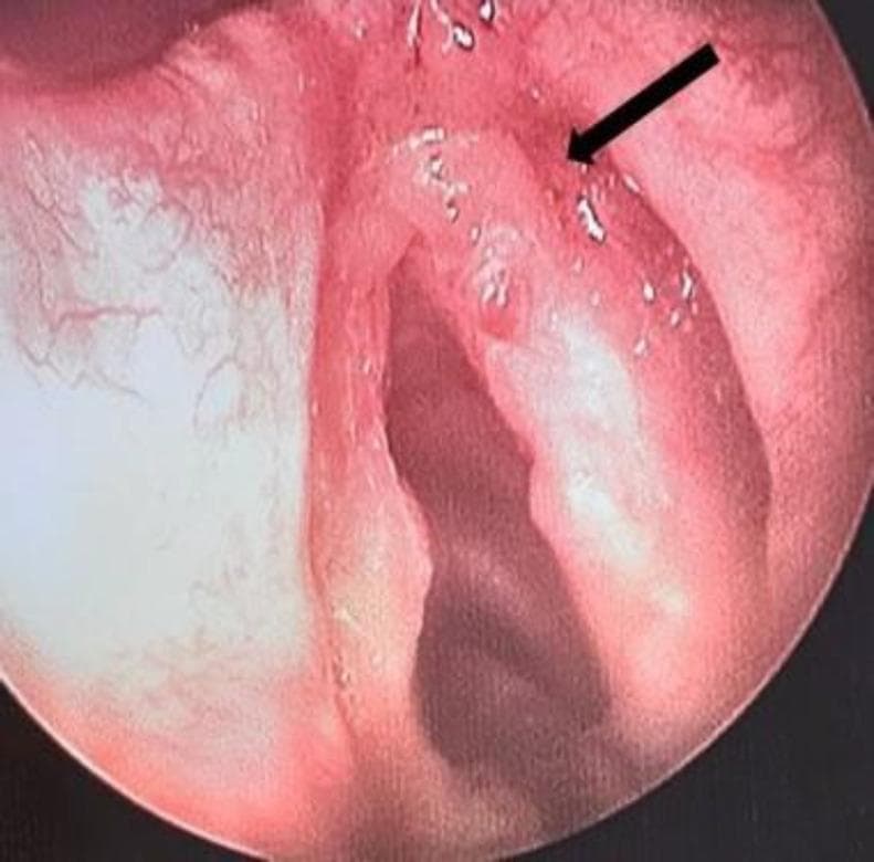 This diagnostic endoscopic image, obtained via direct laryngoscopy, demonstrates the anatomical structures of the larynx with a focus on the true vocal folds. A prominent, irregular polypoidal lesion is visible on the anterior half of the right vocal cord (indicated by a black arrow), appearing as a localized, protruding mass that disrupts the smooth glottic margin. The surrounding laryngeal mucosa exhibits a pink, healthy appearance without evidence of generalized edema or significant inflammatory erythema. The contralateral (left) vocal cord appears normal in morphology and surface texture. Clinically, such lesions are common causes of persistent or intermittent hoarseness and require surgical excision and histopathological analysis to differentiate between benign entities like laryngeal myxoma or vocal polyps and malignant pathologies. This visual is representative of Otolaryngology (ENT) diagnostic imaging for upper airway evaluation.