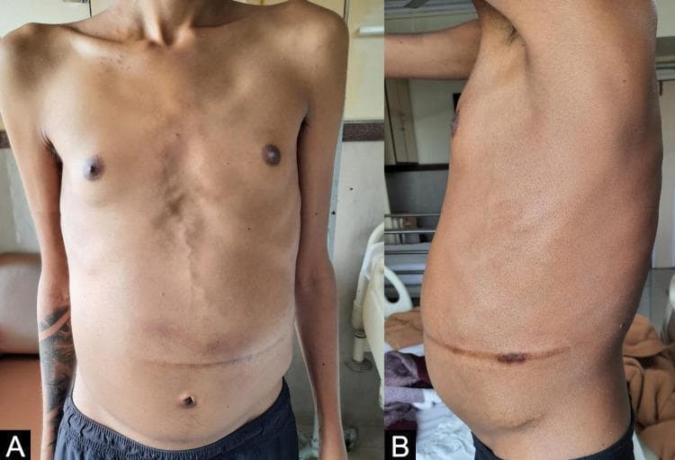 Clinical photograph of a male patient presenting with signs of portal hypertension and chronic systemic illness, captured in anterior (A) and lateral (B) views. The images demonstrate significant abdominal distension consistent with ascites, although according to clinical context, this represents a post-Transjugular Intrahepatic Portosystemic Shunt (TIPS) state with partial resolution. Notable features include prominent vertical venous dilation (caput medusae) along the abdominal midline and a transverse supra-umbilical surgical scar. The patient exhibits a sarcopenic body habitus, characterized by visible clavicles, reduced muscle mass in the upper torso, and a thin appearance relative to the distended abdomen. This presentation is characteristic of complications from Gaucher disease and secondary cirrhosis, demonstrating the physical manifestations of chronic liver disease, portosystemic collateral circulation, and nutritional depletion.