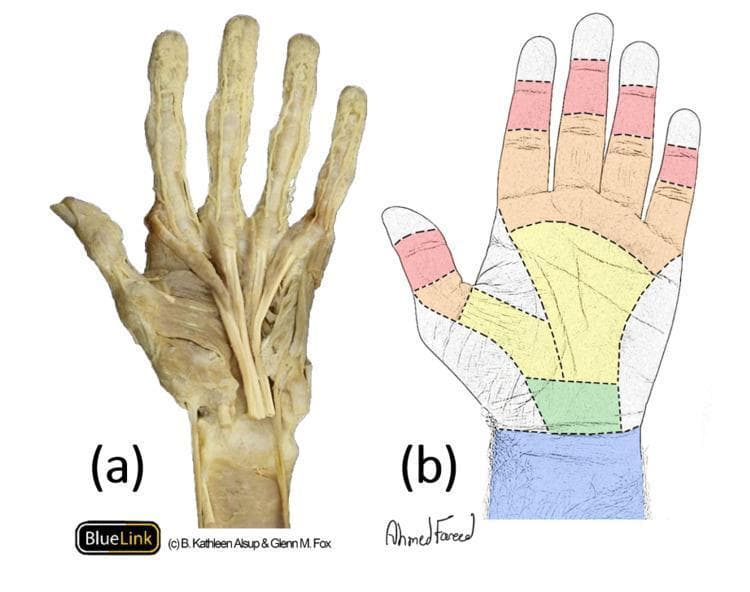 This medical visual consists of two parts illustrating the anatomy of the flexor tendons and the five surgical flexor zones of the hand. Image (a) is a cadaveric dissection of a left hand and distal forearm, showcasing the longitudinal orientation of the flexor digitorum tendons. The tendons are visible as robust, whitish fibrous cords emerging from the carpal tunnel and splaying out across the palm toward each digit. Image (b) is a color-coded surface anatomy diagram representing the five surgical flexor zones used in orthopedic surgery to classify injuries. Zone I (red) is the most distal, extending from the flexor digitorum profundus (FDP) insertion to the flexor digitorum superficialis (FDS) insertion. Zone II (orange), often termed 'no man's land,' spans the fingers from the FDS insertion to the distal palmar crease. Zone III (yellow) covers the central palm. Zone IV (green) corresponds to the carpal tunnel region, and Zone V (blue) extends proximally from the carpal tunnel into the forearm's musculotendinous junction.