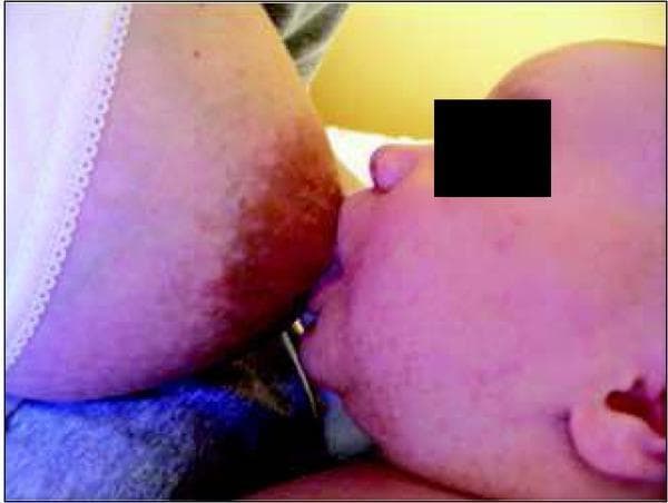 Clinical photograph demonstrating an incorrect, shallow breastfeeding latch in an infant. The image shows the infant's mouth attached to the breast with a narrow angle of opening, rather than a wide-gaped seal. A significant portion of the maternal areola is visible above the infant's upper lip, while very little areolar tissue is captured below the lower lip, indicating that the infant is primarily grasping the nipple rather than the underlying breast tissue. This positioning is characteristic of a 'shallow hold,' which can lead to nipple trauma for the mother and inefficient milk transfer for the infant. The photograph serves as an educational tool in lactation consultancy and pediatrics to distinguish between suboptimal and optimal latch mechanics and their impact on craniofacial development and breastfeeding success.