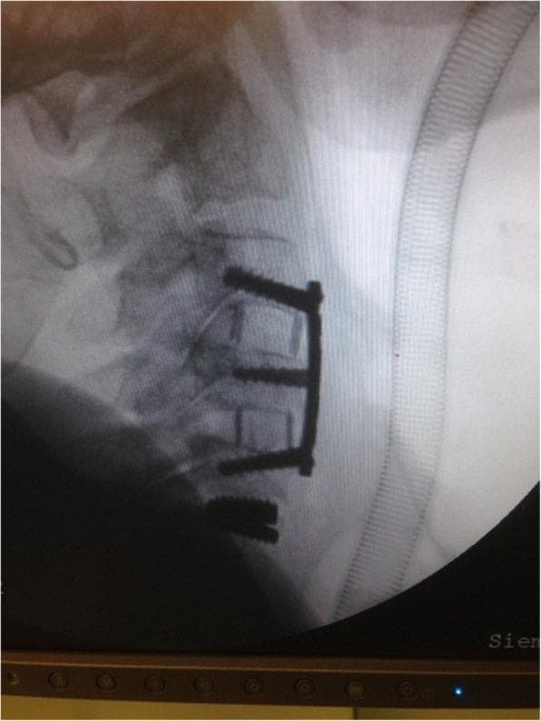 This lateral cervical spine radiograph demonstrates a complex hybrid surgical reconstruction involving multi-level stabilization. The image shows an Anterior Cervical Discectomy and Fusion (ACDF) construct spanning from C3 to C6. This consists of a radiopaque anterior cervical plate secured with three pairs of screws into the vertebral bodies. Within the intervertebral spaces at C3-C4 and C5-C6, interbody fusion cages are visible, designed to maintain disc height and promote osteosynthesis. Notably, at the C6-C7 level, a cervical disc prosthesis (artificial disc) is implanted, appearing as a distinct metal-on-metal or composite device designed to preserve motion at that segment. The alignment of the cervical vertebrae is maintained, and the hardware appears intact without evidence of migration or loosening. This case illustrates a 'hybrid' surgical approach, combining rigid fusion for spondylosis with motion-preserving arthroplasty to mitigate adjacent segment disease. An endotracheal tube or similar medical tubing is partially visible anterior to the neck, suggesting an intraoperative or immediate postoperative setting.