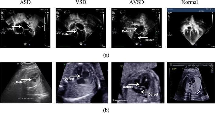 This diagnostic comparison chart features two rows of grayscale ultrasound images demonstrating congenital cardiac septal defects. Row (a) presents postnatal echocardiograms, and row (b) displays prenatal (fetal) echocardiograms. The columns categorize the findings into four types: Atrial Septal Defect (ASD), Ventricular Septal Defect (VSD), Atrioventricular Septal Defect (AVSD), and Normal anatomy. Across both rows, white arrows labeled 'Defect' indicate specific anatomical interruptions. The ASD images highlight a gap in the interatrial septum, while the VSD images show an opening in the interventricular septum. The AVSD panel demonstrates a larger communication involving both septa, resulting in a common atrioventricular junction. The 'Normal' column provides a reference for intact septal integrity and clear chamber separation in the apical four-chamber view. The prenatal scans (row b) demonstrate typical fetal imaging characteristics, including surrounding uterine and fetal structures, compared to the more focused cardiac imaging of the postnatal scans. This visual comparison is designed for pediatric cardiology education, focusing on the identification of septal morphology across developmental stages.