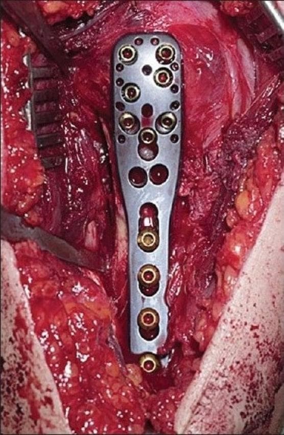 This clinical photograph captures an intraoperative view of an orthopedic surgical procedure for a proximal humerus fracture. The primary focus is a silver-toned Proximal Humeral Interlocking System (PHILOS) plate securely fixed to the bone. The plate features an anatomically shaped widened head at the proximal end, containing multiple multidirectional locking screw holes to support the articular surface. Several locking screws are visible within these proximal holes, oriented at convergent and divergent angles. The distal portion consists of a narrower shaft containing vertical rows of screw holes, where bicortical locking screws are seen fixing the plate to the humeral diaphysis. The surrounding surgical field demonstrates a deltopectoral approach with retracted soft tissues, exposing deep musculature and fatty tissue. Surgical retractors are visible at the periphery, maintaining the operative window. This image serves as an educational tool for demonstrating internal fixation techniques, the configuration of specialized locking plates, and surgical anatomy during fracture management in orthopedic surgery.