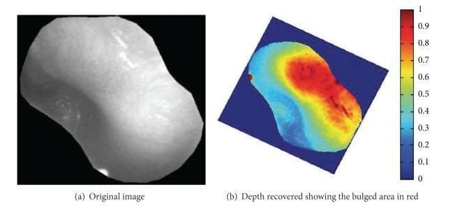 This medical figure illustrates the computational analysis of a tympanic membrane for diagnosing acute otitis media (AOM). (a) A grayscale clinical photograph of a tympanic membrane obtained via otoscopy shows a smooth, opaque surface with subtle brightness variations and a specular highlight from the otoscope's light source. (b) A corresponding depth map generated using shape-from-shading techniques. Depth information is visualized via a pseudocolor gradient (ranging from blue for low depth to red for high depth/bulging). A prominent red region in the upper and central portions of the membrane indicates significant bulging, a primary diagnostic indicator of AOM. This comparative visualization demonstrates how 2D image data can be transformed into 3D topographical information to assist in the automated classification of middle-ear inflammation and the identification of pathological protrusions.