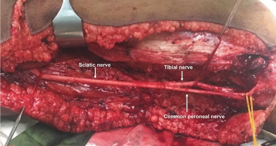 This clinical photograph shows a detailed intraoperative view of a surgical dissection in the posterior thigh region, focusing on the sciatic nerve and its bifurcation. The surgical field reveals the sciatic nerve as a prominent, thick, white cord-like structure running longitudinally. It is shown bifurcating into its two terminal branches: the larger tibial nerve and the relatively smaller common peroneal (common fibular) nerve, proximal to the popliteal fossa. The nerves are clearly isolated from the surrounding deep fascia and red muscle tissue (likely the biceps femoris and semimembranosus/semitendinosus group). Surgical retractors and a metallic probe are visible at the periphery, maintaining exposure of the neurovascular bundle. Yellow vessel loops are used to isolate and protect the distal nerve branches. The image demonstrates the anatomical preservation of critical neural structures during a complex oncological resection (osteosarcoma surgery). This serves as a high-level educational resource for surgical anatomy, orthopedic oncology, and peripheral nerve identification.