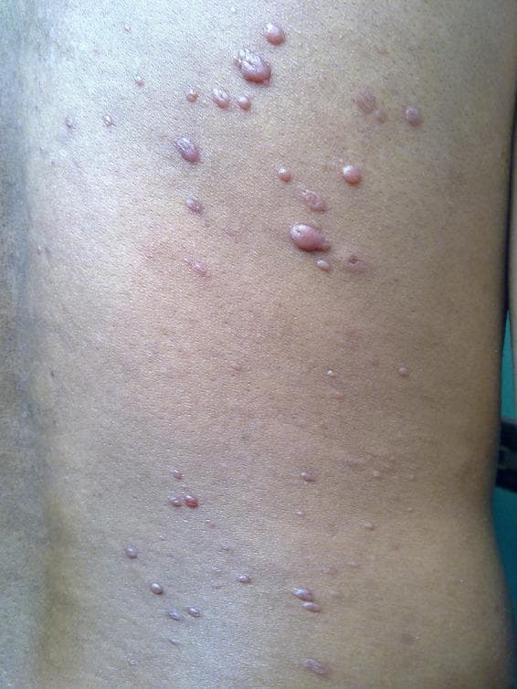 This clinical photograph shows the trunk of a patient featuring numerous discrete, skin-colored to slightly erythematous nodules. The lesions are characteristic of histoid leprosy, a distinct variant of lepromatous leprosy. The nodules are well-demarcated, varying in size from approximately 0.5 to 1.0 cm, with a notably shiny, smooth, and tense surface. Their distribution is scattered across the back and flank, with morphology ranging from firm, dome-shaped papules to larger, raised, succulent nodules. Unlike typical lepromatous leprosy lesions which may be ill-defined, these nodules appear sharply circumscribed and arise from otherwise normal-looking skin. The visual presentation is a classic example of cutaneous manifestations in multibacillary leprosy, used in medical education to differentiate histoid leprosy from other nodular skin conditions such as neurofibromatosis or dermatofibromas.