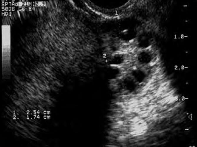 This diagnostic image is a transvaginal ultrasound (sonogram) of a human ovary, illustrating the classic morphological features of polycystic ovary syndrome (PCOS). The image shows an enlarged ovary containing numerous small, well-defined, hypoechoic (fluid-filled) cystic structures distributed primarily in the peripheral stroma, often referred to as the 'string of pearls' sign. There are at least eight visible follicles of varying diameters. Two linear calipers mark the dimensions of the ovary, with measurements recorded at 2.54 cm and 1.74 cm. The ovarian stroma appears relatively hyperechoic and prominent. The image also exhibits characteristic ultrasound speckle artifact throughout the tissue. This visual is used in medical education to demonstrate the 'polycystic' component of the Rotterdam criteria for diagnosing PCOS, emphasizing the specific distribution and quantity of follicles and the increase in overall ovarian volume.