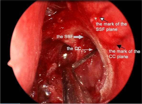 This endoscopic clinical photograph depicts a surgical field during an endoscopic dacryocystorhinostomy (DCR). The circular frame shows a view of the lateral nasal wall where the lacrimal sac has been exposed through marsupialization. Key anatomical structures identified include the sac superior fundus (SSF), marked with a gray arrow at the superior aspect of the sac, and the common canaliculus (CC) opening, indicated by a second gray arrow. To ensure anatomical accuracy, two preoperative reference markings are visible on the surrounding nasal mucosa as shallow horizontal incisions: a white arrow with a black edge points to the SSF plane mark, and a solid black arrow points to the CC plane mark. These markings are oriented at right angles to the long axis of the lacrimal sac. A surgical probe or instrument is seen entering from the inferior aspect of the frame to assist in localizing and measuring these structures. This visual demonstrates the verification of preoperative surface landmarks against actual intranasal anatomy for effective lacrimal system drainage.