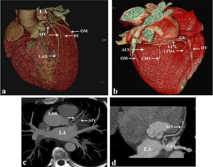 This set of diagnostic images from multidetector coronary CT (MDCT) illustrates the cardiac vasculature and a rare congenital anomaly. Panels (a) and (b) show 3D volume-rendered reconstructions of the heart. Panel (a) highlights the anterior surface where the anterior interventricular vein (AIV) and left anterior descending artery (LAD) course together in the interventricular sulcus. Notably, the AIV is seen passing deep to the first diagonal artery (D1). Panel (b) shows the posterior/inferior cardiac view including the coronary sinus (CS), left circumflex artery (LCx), and inferior interventricular vein (IIV). Panels (c) and (d) utilize oblique maximum intensity projection (MIP) and curved reformatted views to demonstrate the anomalous drainage of the AIV directly into the left atrium (LA) rather than the coronary sinus. Key structures labeled include the left atrial appendage (LAA), obtuse marginal artery (OM), and left marginal vein (LMV). This educational material demonstrates the utility of advanced cardiac CT imaging in identifying venous anomalies and defining complex spatial relationships between coronary arteries and veins for clinical diagnosis or surgical planning.