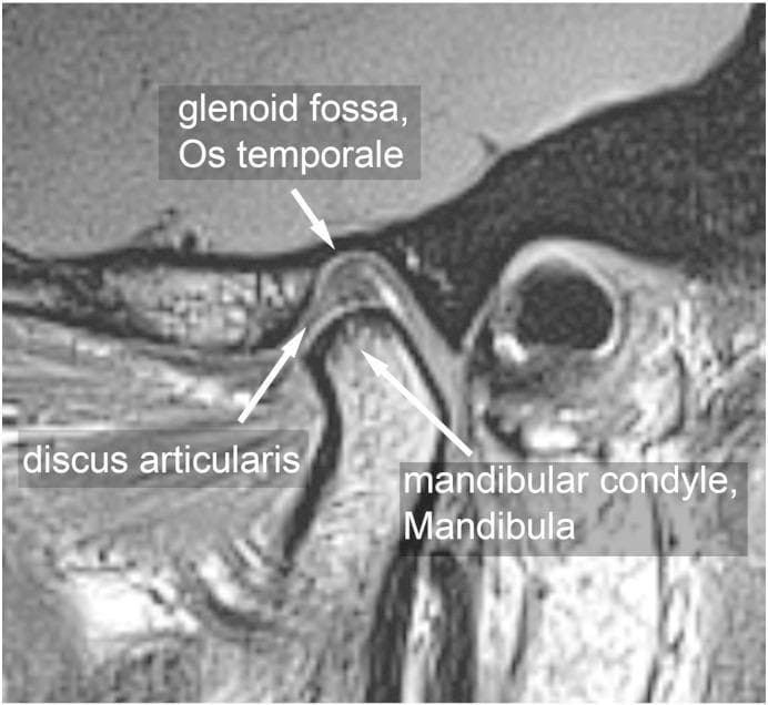 This diagnostic image is a parasagittal Magnetic Resonance Imaging (MRI) scan demonstrating the normal anatomy of the human temporomandibular joint (TMJ) in an asymptomatic individual. The image clearly labels three primary components: the glenoid fossa (Os temporale), the articular disc (discus articularis), and the mandibular condyle (Mandibula). The biconcave articular disc is shown in a physiological position, interposed between the superior glenoid fossa and the inferiorly positioned mandibular condyle. The condyle exhibits a smooth, rounded morphology sitting within the mandibular fossa, illustrating proper joint alignment. The cortical boundaries of the temporal bone and mandible appear intact. This visual serves as an educational reference for normal maxillofacial anatomy, joint articulation, and standard radiological presentation of the TMJ in the closed-mouth or neutral position. It is relevant for dental, orthodontic, and radiological training to differentiate healthy joint structures from those affected by temporomandibular disorders (TMD).