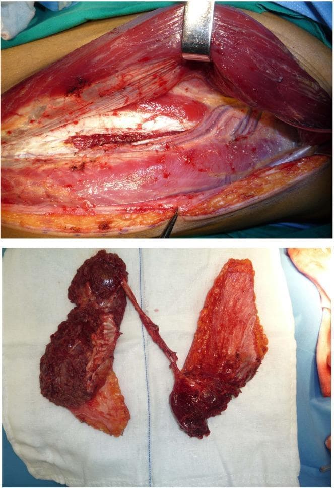 Clinical photograph of a surgical procedure involving the harvest of a branch-based anterolateral thigh (ALT) flap for reconstructive surgery. The top panel shows the donor site in the thigh under surgical retraction. Key anatomical structures visible include the vastus lateralis muscle being retracted, underlying vascular structures, and deep fascia. Dissection of the subcutaneous adipose tissue and muscle is evident, exposing the descending and oblique branches of the lateral circumflex femoral artery. The bottom panel displays the harvested chimeric flap on a white sterile surgical towel. The flap is composed of two distinct tissue blocks: one primarily muscular and thicker in appearance, and the other consisting of a skin paddle with underlying adipose and muscle components. Both blocks remain connected via a common vascular pedicle, demonstrating the flap's versatility for reconstructing complex, multi-site or 'Type B' soft tissue defects. The image illustrates advanced microsurgical techniques in head and neck reconstruction using chimeric free flaps.