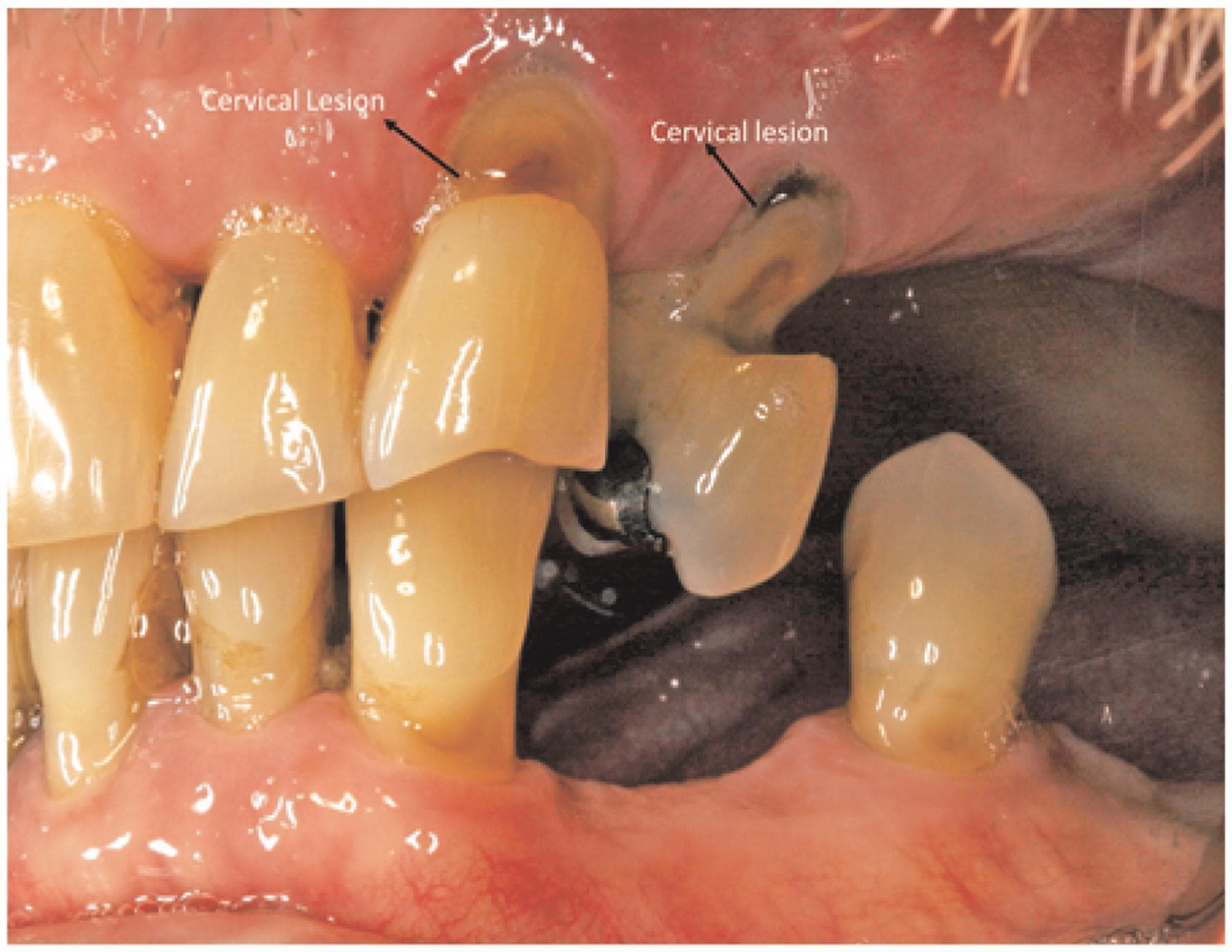 This clinical intraoral photograph demonstrates non-carious cervical lesions (NCCLs) on multiple teeth. The image highlights two primary areas of interest with arrows and text labels. One lesion, located on an upper tooth toward the center of the image, presents as an oval-shaped, yellowish-brown area of tooth loss at the cervical margin, near the gingival line. A second lesion to the right appears more advanced and darker in color, suggesting significant demineralization or staining. Both lesions occur at the cementoenamel junction, characteristic of conditions such as dental erosion, abrasion, or abfraction. The surrounding gingival tissue shows clear signs of pathology, including significant gingival recession, exposure of the anatomical roots, and generalized erythema indicating chronic inflammation. The interdental papillae appear blunted, and there is visible tooth crowding and malalignment. This image is educational for dentistry students and clinicians focusing on periodontology and restorative dentistry, illustrating the relationship between cervical tooth structure loss and gingival health.