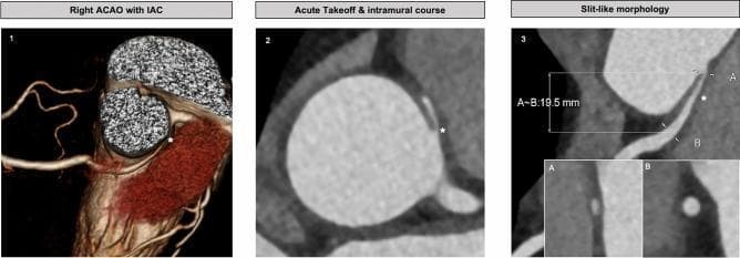 This composite diagnostic image consists of three panels demonstrating high-risk anatomical features of an anomalous origin of a coronary artery arising from the opposite sinus (ACAOS) with an interarterial course (IAC), visualized via Coronary Computed Tomography Angiography (CCTA). Panel 1 provides a 3D reconstruction showing the right coronary artery originating from the left sinus of Valsalva and traversing between the aorta and pulmonary artery. Panel 2 utilizes multiplanar axial reconstruction to highlight an acute takeoff angle and an intramural course, where the vessel is embedded within the aortic wall (indicated by an asterisk). Panel 3 demonstrates 'slit-like morphology' in a double oblique view. It quantifies the proximal luminal narrowing (Point A) compared to a distal reference point (Point B), with an interarterial course length measurement of 19.5 mm. These features are clinically significant as markers for potential myocardial ischemia or sudden cardiac death, facilitating surgical planning and risk stratification in cardiology and radiology.