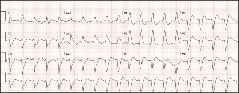 This diagnostic image is a 12-lead electrocardiogram (ECG) demonstrating a wide-complex tachycardia with a ventricular rate of approximately 116 beats per minute and a QRS duration of approximately 200 ms. The ECG shows a regular rhythm with significantly widened QRS complexes and bizarre morphology, suggestive of a ventricular origin or severe intraventricular conduction delay. In the precordial leads, V1 and V2 exhibit tall, peaked R-waves with slurred upstrokes, while V4 through V6 show deep S-waves and discordant T-waves. The limb leads (I, II, III, aVR, aVL, aVF) demonstrate varied morphology with notching and slurring. No clear P-waves are discernible preceding the QRS complexes, which is characteristic of ventricular tachycardia or a highly aberrant supraventricular rhythm. The clinical focus of this visual is to illustrate the features of wide-complex tachycardia in an emergency clinical setting, emphasizing the importance of recognizing prolonged QRS intervals and atypical wave morphology for rapid triage and Advanced Cardiovascular Life Support (ACLS) intervention.