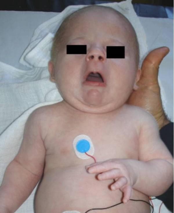 This clinical photograph displays an infant with a cluster of dysmorphic features and physical findings characteristic of a systemic syndrome, such as Stuve-Wiedemann syndrome. Key facial findings include an expressionless (mask-like) facies, blepharophimosis (narrowing of the palpebral fissures, here obscured by black privacy boxes), and a distinctive small, pursed mouth that remains partially open. Musculoskeletal examination reveals multiple joint contractures, most notably camptodactyly (permanent flexion) of the fingers on the left hand. The abdomen shows fullness, and the clinical history notes an umbilical hernia. The infant is placed in a clinical setting, evidenced by the presence of pediatric ECG monitoring electrodes on the chest and abdomen. The skin appears pale and smooth with subcutaneous fullness. This image serves as a teaching tool for recognizing neonatal dysmorphology, neuromuscular contractures, and specific facial phenotypes associated with rare genetic bone dysplasias or signaling pathway mutations (e.g., LIFR gene).