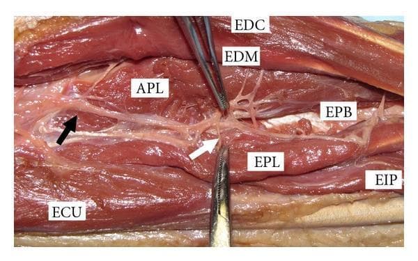 This clinical anatomical photograph displays a cadaveric gross dissection of the human dorsal forearm, highlighting the muscular and nervous anatomy. The image focuses on the extensor compartment, with several muscles clearly labeled: the extensor digitorum communis (EDC), extensor digiti minimi (EDM), abductor pollicis longus (APL), extensor carpi ulnaris (ECU), extensor pollicis brevis (EPB), extensor pollicis longus (EPL), and extensor indicis proprius (EIP). Centrally, the posterior interosseous nerve (PIN) is visible as it exits the arcade of Frohse (indicated by a black arrow). A specific terminal branch of the PIN is shown extending towards the EPL muscle (highlighted by a white arrow). Surgical forceps are positioned to retract tissue, providing a clear view of the neurovascular relationship and the distal innervation pattern of the deep extensor muscles. This visual serves as a critical educational resource for understanding Zone IX forearm anatomy, particularly for neurovascular preservation during surgical procedures or trauma management.