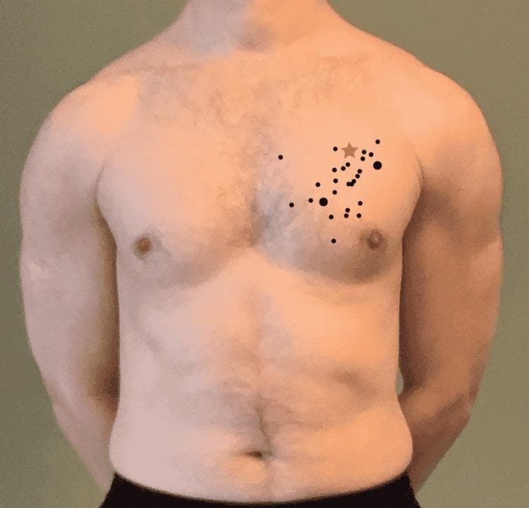 A clinical photograph of a male torso demonstrating anatomical landmark identification for needle decompression. A series of black dots are superimposed over the left pectoral region, representing various identification attempts of the second intercostal space at the mid-clavicular line (MCL) by medical practitioners. The dots vary in size to indicate frequency, with larger dots representing areas selected by multiple participants. A tan star icon denotes the anatomically correct location of the second intercostal space at the mid-clavicular line. The visual serves to illustrate common inaccuracies in identifying thoracic landmarks for emergent procedures such as tension pneumothorax decompression. The image highlights the discrepancy between clinical practice and anatomical accuracy in a medical education context.