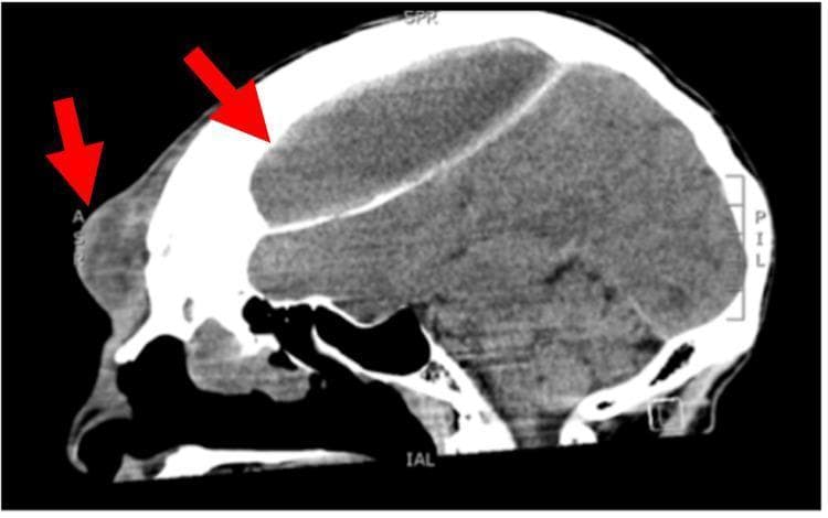 This diagnostic image is a non-contrast sagittal CT scan of the head and facial bones illustrating a large frontal mucocele with significant intra- and extracranial extension. Red arrows highlight two key components of the pathology: a localized bulging mass in the subcutaneous forehead tissue and a massive, biconvex-shaped intracranial collection. The frontal sinus appears opacified and expanded, with clear evidence of bony erosion and destruction of both the anterior and posterior cortical tables of the frontal bone. The intracranial portion of the mucocele occupies a substantial volume of the anterior cranial vault, exerting a significant mass effect on the underlying frontal lobes, characterized by downward displacement and compression of the brain parenchyma. The density of the collection is heterogeneous, suggesting inspissated mucus or secondary infection (Pott's puffy tumor clinical presentation). This scan demonstrates the potential for paranasal sinus pathology to result in advanced cranial complications and structural remodeling.