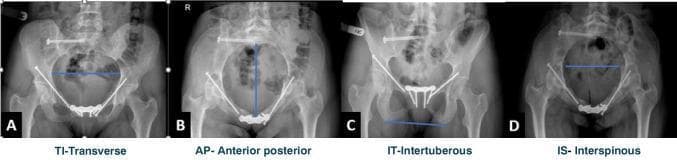 A series of four postoperative anteroposterior, inlet, and outlet pelvic X-rays demonstrating radiographic pelvimetry measurements using the Colcher-Sussman technique. The images show a pelvis with orthopedic hardware, including sacroiliac screws and pubic symphysis plating, indicating prior surgical fixation. Frame A (Transverse Inlet Diameter) shows a horizontal blue line representing the widest diameter of the pelvic inlet between the iliopectineal lines. Frame B (Anteroposterior Distance) illustrates a vertical midline from the anterior pubic symphysis to the sacrum on an inlet view. Frame C (Intertuberous Distance) depicts a transverse line at the pelvic outlet between the inferior margins of the ischial tuberosities. Frame D (Interspinous Distance) shows the mid-pelvic transverse diameter measured between the ischial spines. These diagnostic images are used in orthopedics and obstetrics to assess pelvic dimensions and symmetry following pelvic ring fractures and surgical reconstruction.