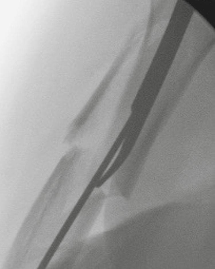 This diagnostic fluoroscopic image illustrates an intraoperative view of a humeral shaft fracture during an orthopedic surgical procedure. The fracture is localized to the mid-diaphysis and appears comminuted, with at least two primary bone fragments and visible smaller intermediary fragments. Significant displacement and lateral angulation are evident at the fracture site. A radiopaque, elongated intramedullary (IM) reduction rod is visualized within the medullary canal. The rod is positioned to span the fracture gap, serving as a joystick-like tool to assist in the anatomical alignment of the proximal and distal fragments. A thin, radiopaque guide wire is seen running parallel to and guided by the reduction tool, which is a critical step for subsequent reaming and the permanent placement of an intramedullary nail. This image demonstrates the clinical application of percutaneous reduction techniques in managing complex humeral fractures to minimize soft tissue disruption while achieving mechanical stability.