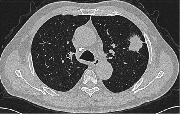 This diagnostic image is an axial contrast-enhanced chest computed tomography (CT) scan displayed in a lung window. The primary finding is a solitary pulmonary nodule located in the left upper lobe of the lung. The mass measures approximately 3.8 x 3.4 cm and exhibits irregular, lobulated, and spiculated margins, which are characteristic features of malignancy. The density of the lesion is solid and significantly higher than the surrounding pulmonary parenchyma, without evidence of internal calcification or cavitation. Anatomical landmarks including the trachea, mediastinal great vessels, and vertebrae are visible in the midline. The right lung appears clear with no visible masses. The chest wall, including the ribs and scapulae, remains intact. This image is used to demonstrate the radiographic presentation of primary lung adenocarcinoma, specifically within the context of tumors containing signet-ring cell components. It serves as an educational example for oncology and radiology students to identify morphological characteristics of lung cancer on CT imaging.