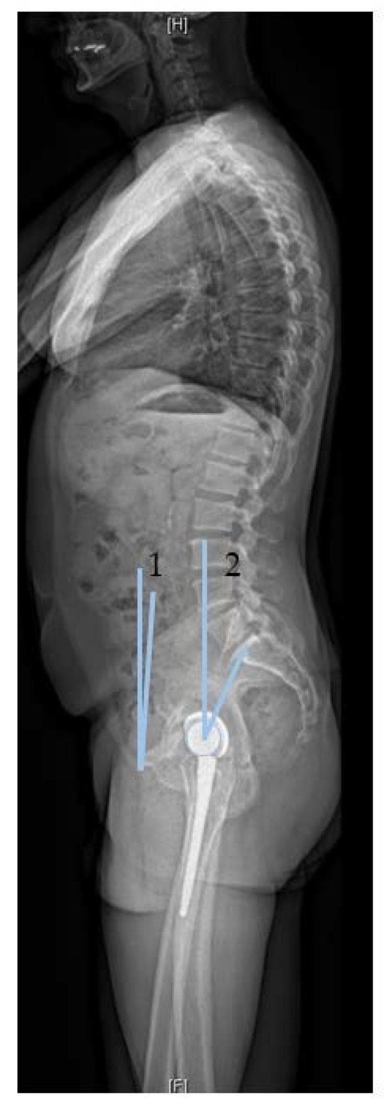 This lateral standing radiograph of the full spine and pelvis illustrates two distinct methods for measuring pelvic tilt in the sagittal plane. The image depicts a patient with a total hip arthroplasty (THA), showing the femoral stem and acetabular cup in situ. Method 1 (Arthroplasty perspective) is marked by line 1, defining the Anterior Pelvic Plane Tilt (APPt) as the angle between the coronal plane and a line connecting the anterior superior iliac spine (ASIS) and the pubic symphysis. Method 2 (Spine surgeon perspective), marked by line 2, illustrates Spinopelvic Tilt (sPT), defined as the angle between a vertical reference line and a line from the center of the femoral heads to the midpoint of the S1 sacral endplate. The radiograph demonstrates clinical landmarks including the thoracic kyphosis, lumbar spine, sacrum, and iliac crests. These measurements are essential for assessing spinopelvic mobility and sagittal balance, particularly in preoperative planning for hip arthroplasty to minimize dislocation risk related to spinal alignment and pelvic retroversion.