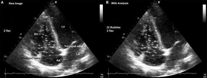 This diagnostic echocardiogram shows a side-by-side comparison of a cardiac four-chamber view used to evaluate venous gas emboli (VGE). Panel A (Raw Image) displays standard anatomical landmarks including the Right Ventricle (RV), Right Atrium (RA), Left Ventricle (LV), Left Atrium (LA), and the tricuspid valve leaflets. Panel B (With Analysis) demonstrates a specialized bubble counting technique where numerous hyperechoic bright spots representing circulating bubbles are identified and circled within the right heart chambers. The educational focus is on distinguishing transient venous gas emboli—often associated with decompression sickness—from fixed cardiac structures such as the tricuspid annulus or papillary muscles. The image is taken from a fifth intercostal space probe placement and includes clinical metadata such as heart rate and count (32 Bubbles). This visual is highly relevant for diving medicine, cardiology, and hyperbaric physiology to illustrate the quantification of post-dive bubble formation.